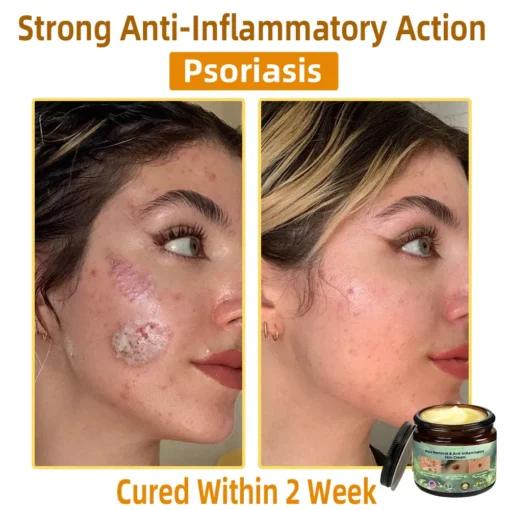 Bostore™ Mole Removal & Anti-Inflammatory Skin Cream